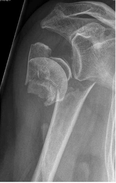 Kopfractuur humerus